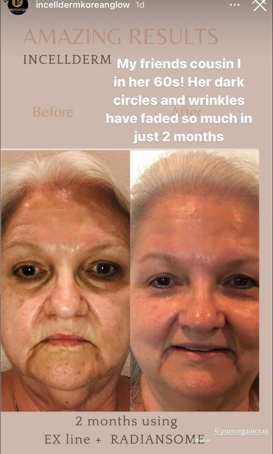 Photo showing before and after results of skincare treatment with Incellderm, highlighting reduced dark circles and wrinkles.