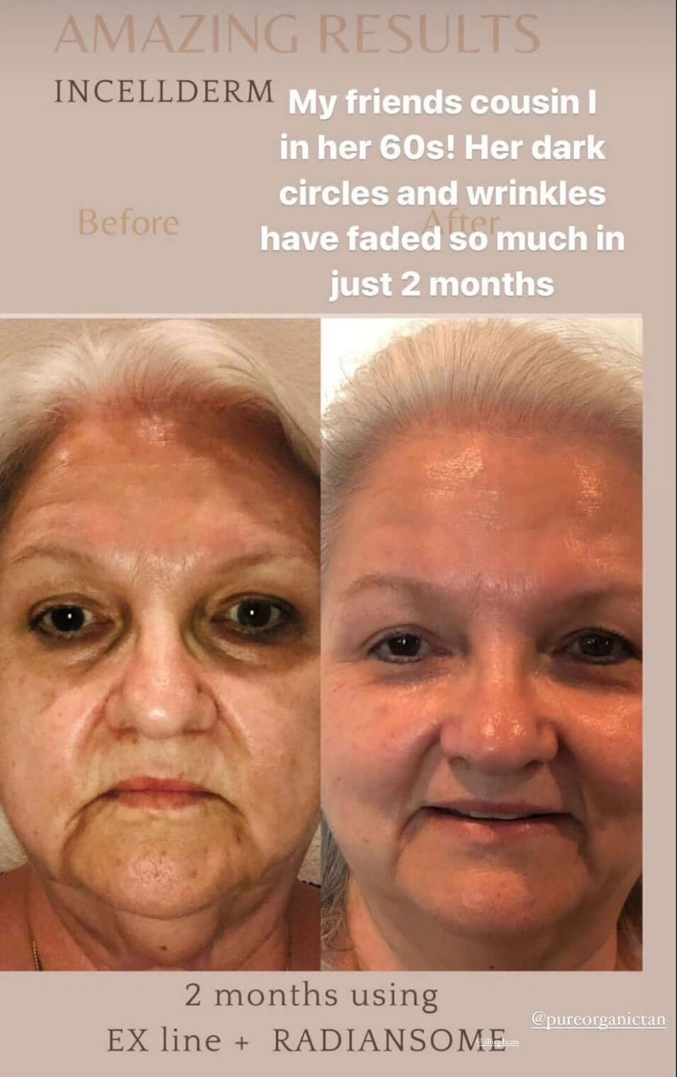 Before and after photo showing significant improvement in skin texture and reduced wrinkles after using Ex Line and Radiansome.