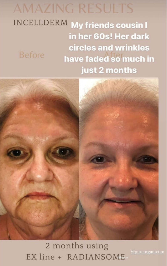 Before and after photo showing significant improvement in skin texture and reduced wrinkles after using Ex Line and Radiansome.